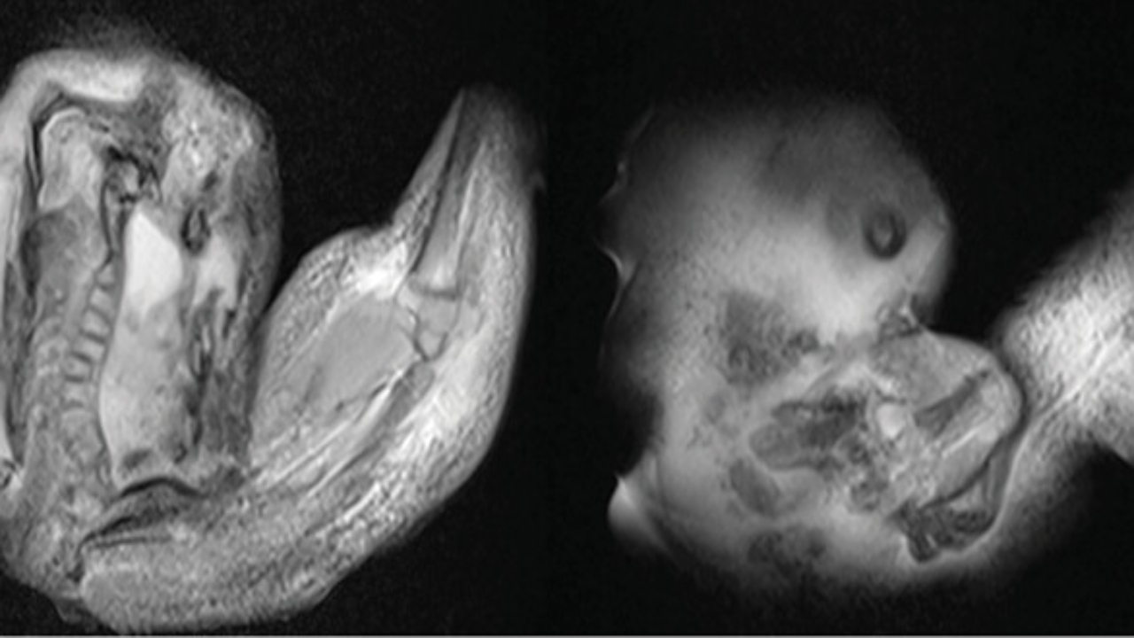 Un gemelo “atrapado”: Así descubrieron un feto dentro del cerebro de una bebé de 1 año