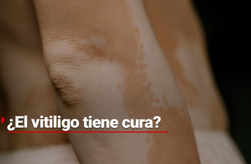 ¿El vitiligo tiene cura? La lucha para que se conozca más sobre esta enfermedad