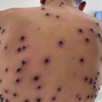 Tamaulipas acumula32 casos de viruela símicaen últimos…