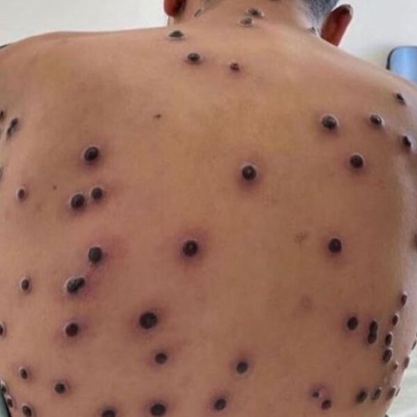 Tamaulipas acumula32 casos de viruela símicaen últimos cuatro años