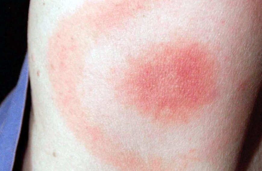 mordedura de garrapata: prevención en Nuevo Laredo