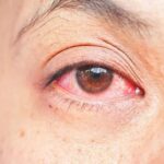 Lluvias disparan casos de conjuntivitis en Tamaulipas; más de 700 en una semana