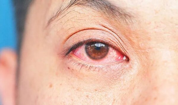 Lluvias disparan casos de conjuntivitis en Tamaulipas; más de 700 en una semana