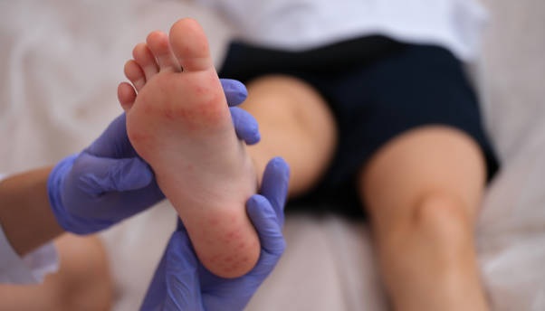 Van 44 brotes de virus coxsackie registrados en Tamaulipas durante 2025