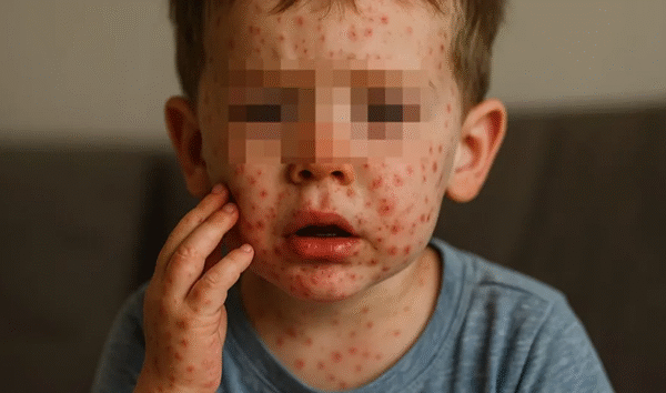 Brote del virus coxsackie provocó suspensión de clases en Tamaulipas y otros 3 estados