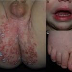 Refuerzan medidas preventivas ante el aumento de casos de la enfermedad de mano-pie-boca