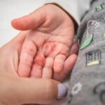 Brotes de virus coxsackie en el sur de Tamaulipas se elevan en una semana