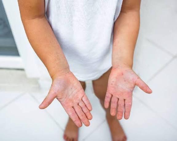 Descarta Salud alerta por virus Mano-Pie-Boca pero exhortan a mantener higiene