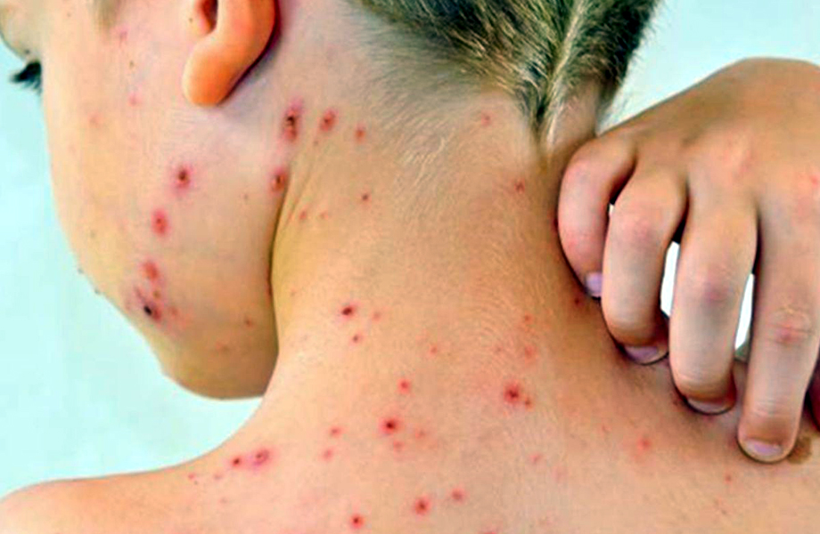 Erupcin cutnea roja en cuello y espalda asociada a sarampin enfermedad viral altamente contagiosa