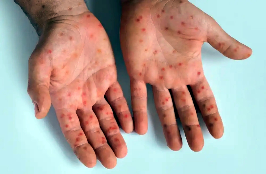 Manchas rojas en las palmas de las manos como posible sntoma de sarampin