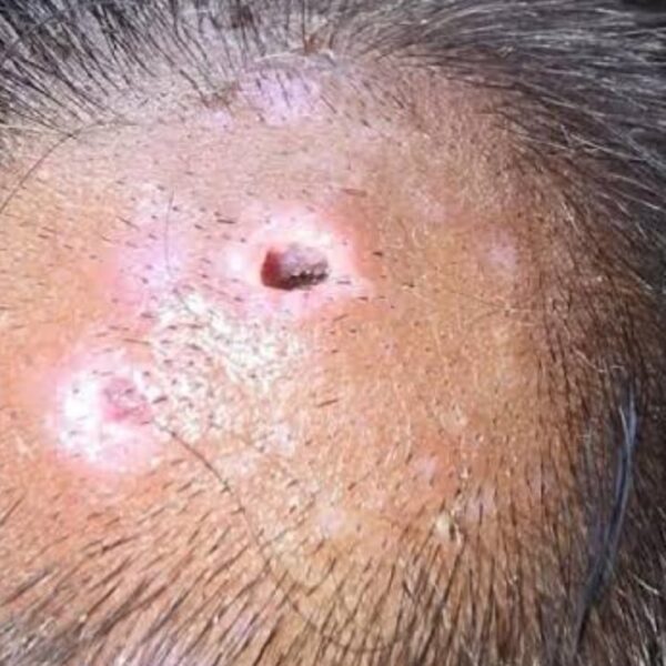 Sur de Tamaulipas propenso a registrar miasis en humanos por gusano barrenador