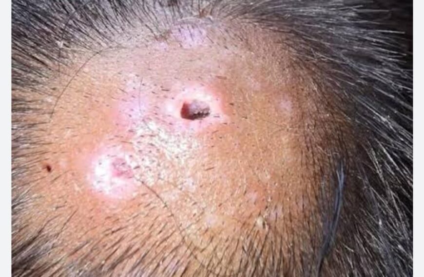 Sur de Tamaulipas propenso a registrar miasis en humanos por gusano barrenador