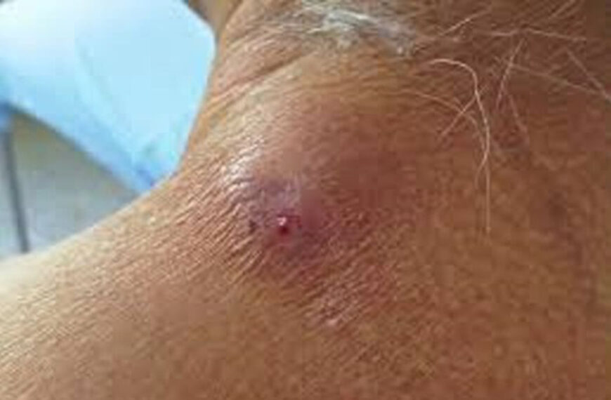 Alerta ante posibles casos de miasis por gusano barrenador en humanos en Tamaulipas