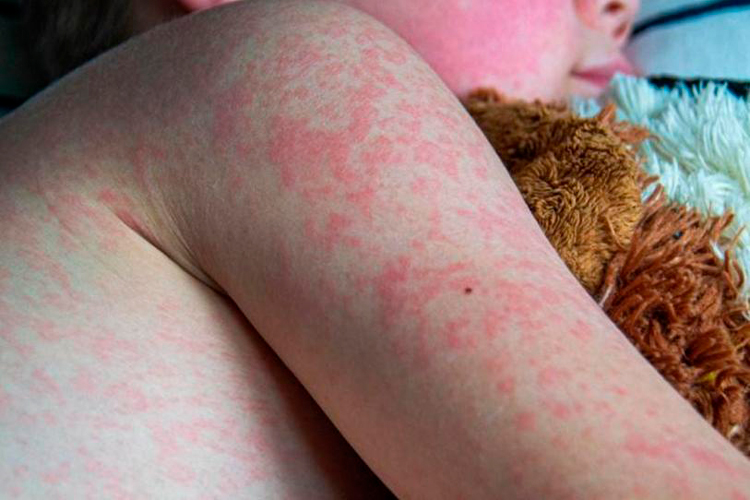 Tamaulipas sin sarampión en lo que va de 2026 pese al brote nacional registrado