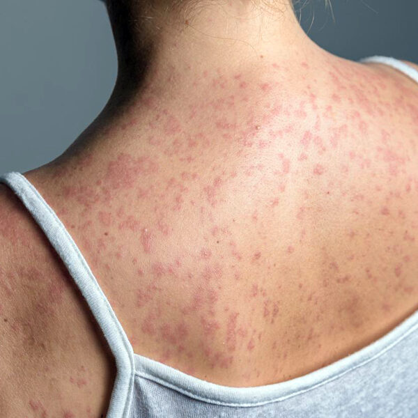 Está en análisis el caso probable de sarampión en Tamaulipas: Salud estatal