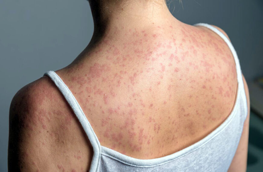 Está en análisis el caso probable de sarampión en Tamaulipas: Salud estatal