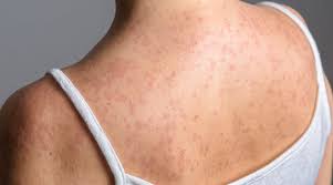 Está en análisis el caso probable de sarampión en Tamaulipas: Salud estatal