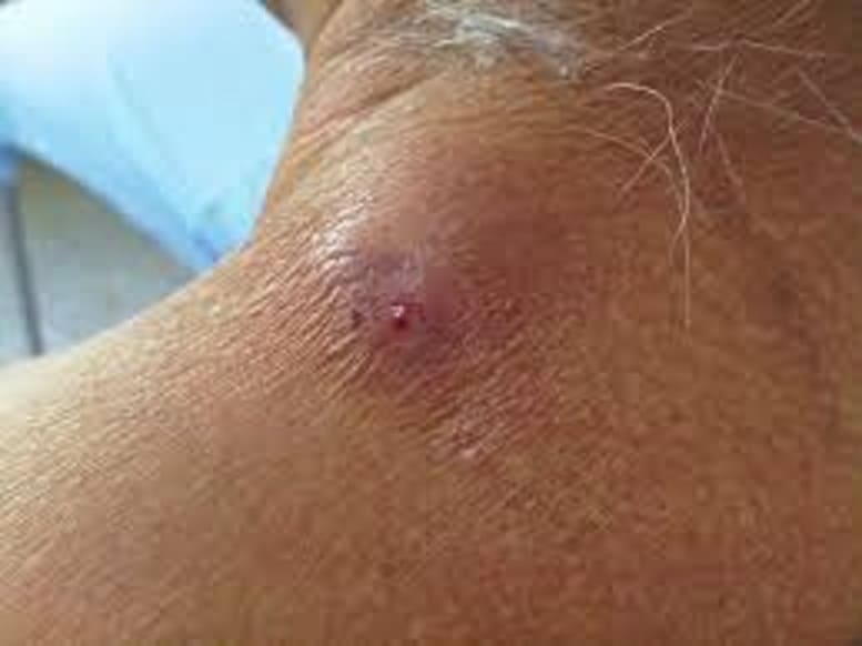 Close-up of neck skin showing a small red-purple bump with surrounding redness, possibly a minor skin infection or insect bite.